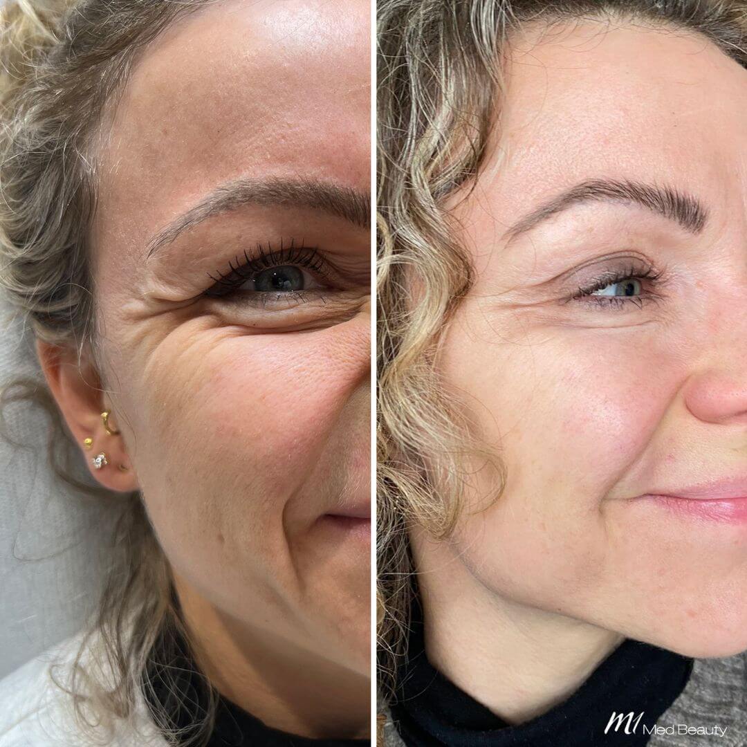 Anti-Wrinkle M1 Beauty (1)