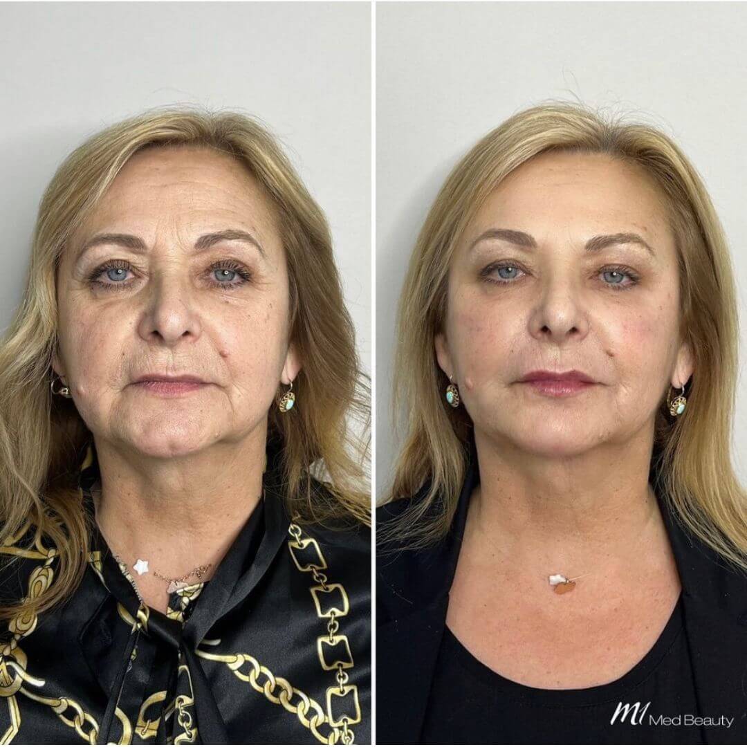 Anti-Wrinkle M1 Beauty (3)