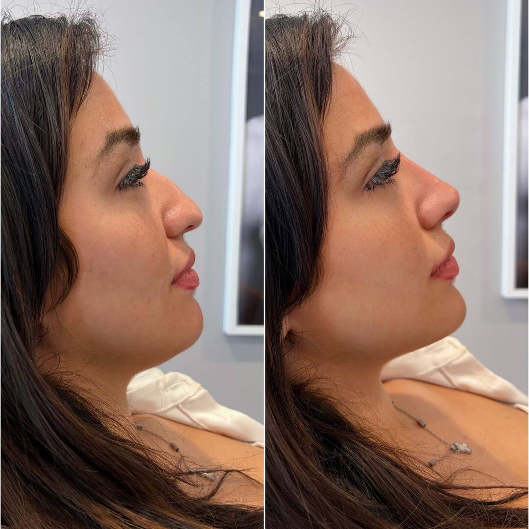 Nose dermal filler M1 Beauty (1)