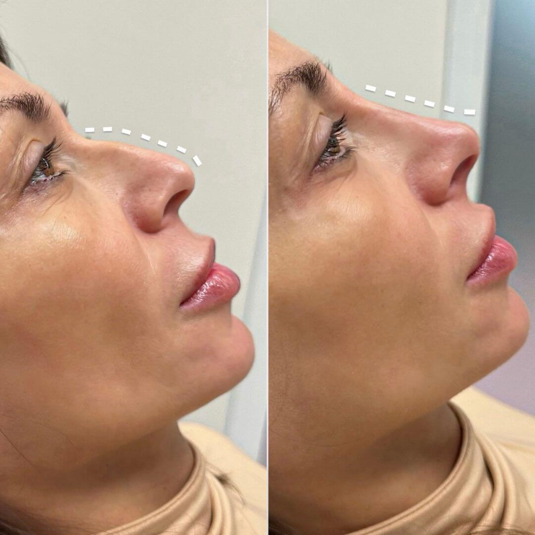 Nose dermal filler M1 Beauty (3)