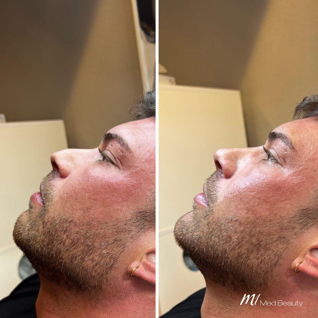 Nose dermal filler M1 Beauty (4)