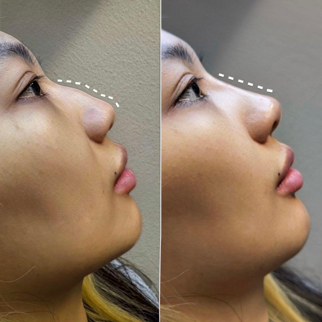 Nose dermal filler M1 Beauty (5)