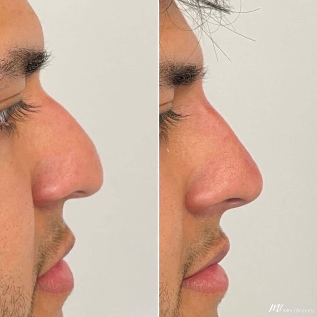 Nose dermal filler M1 Beauty (7)