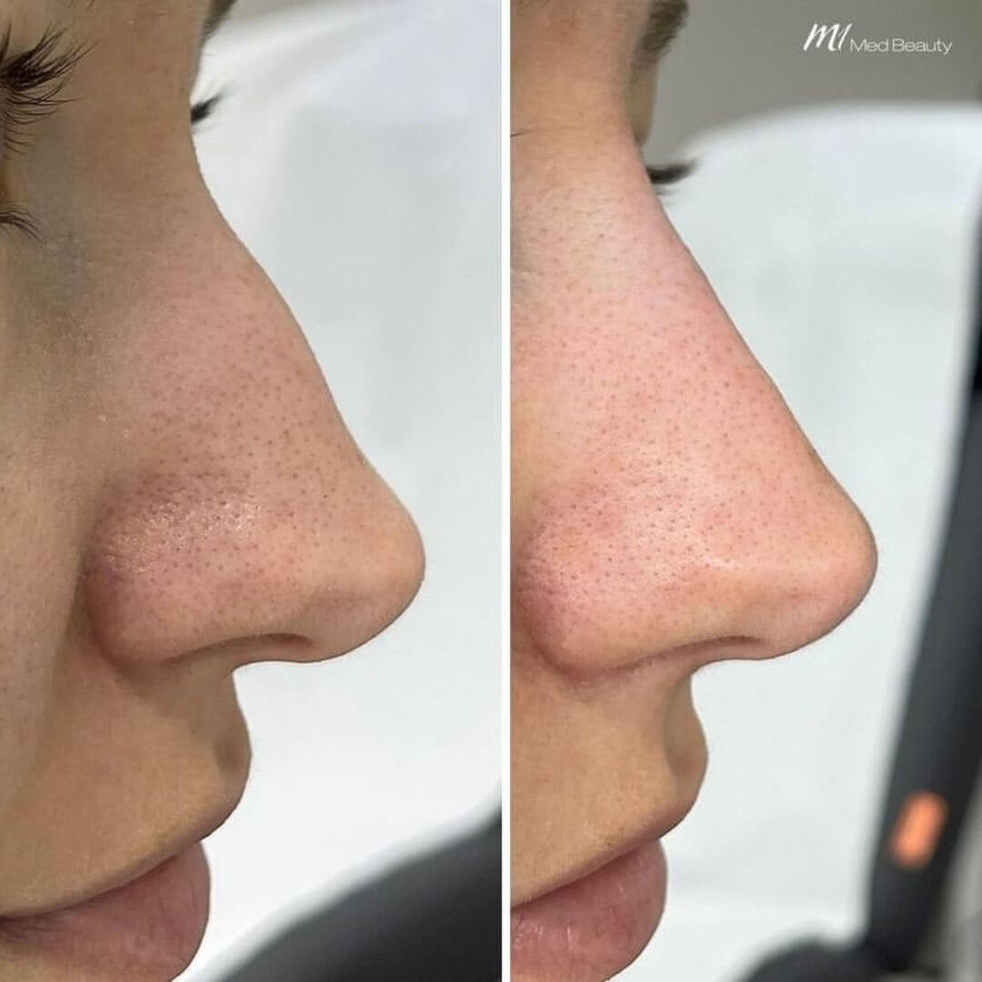 Nose dermal filler M1 Beauty (8)