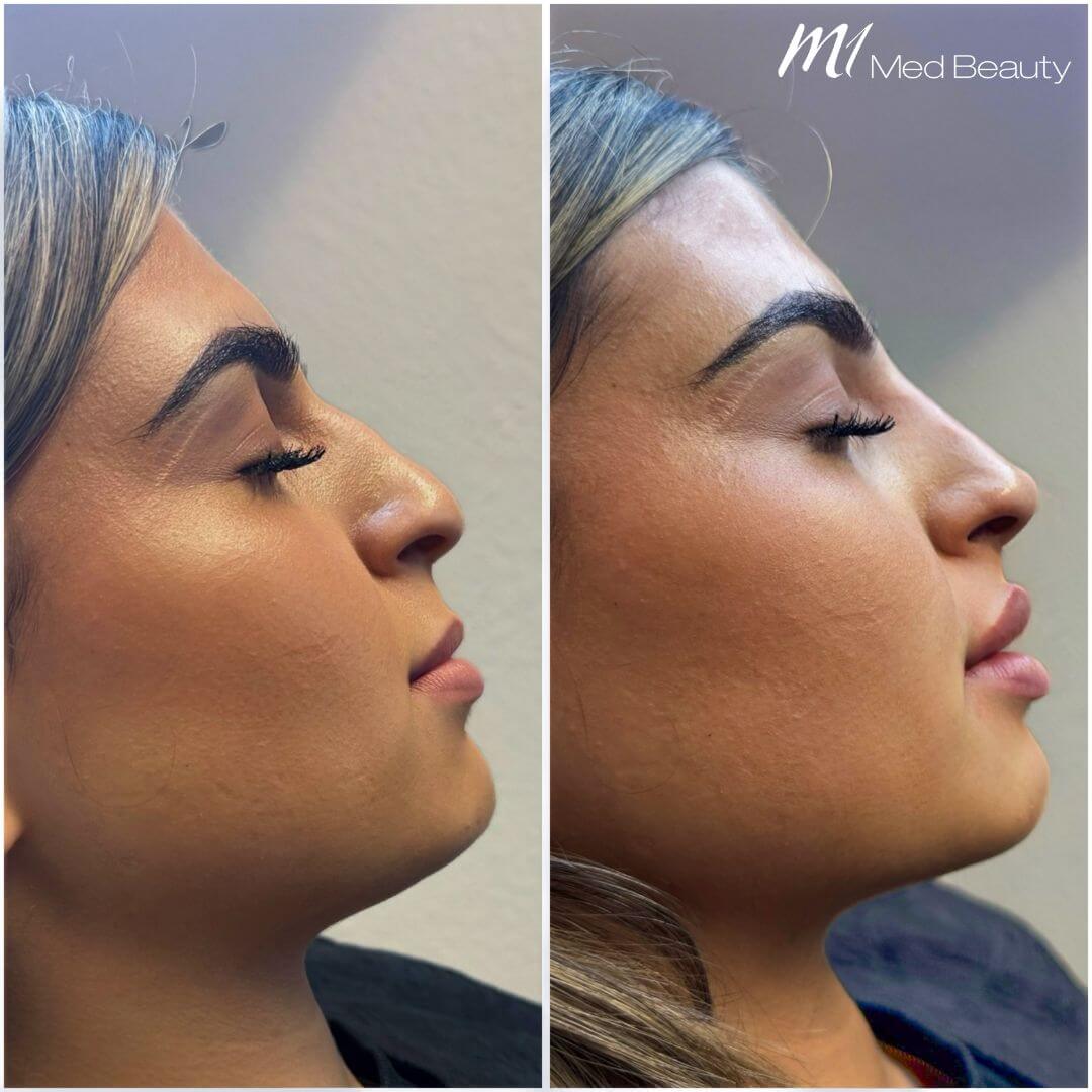 Nose dermal filler M1 Beauty (9)