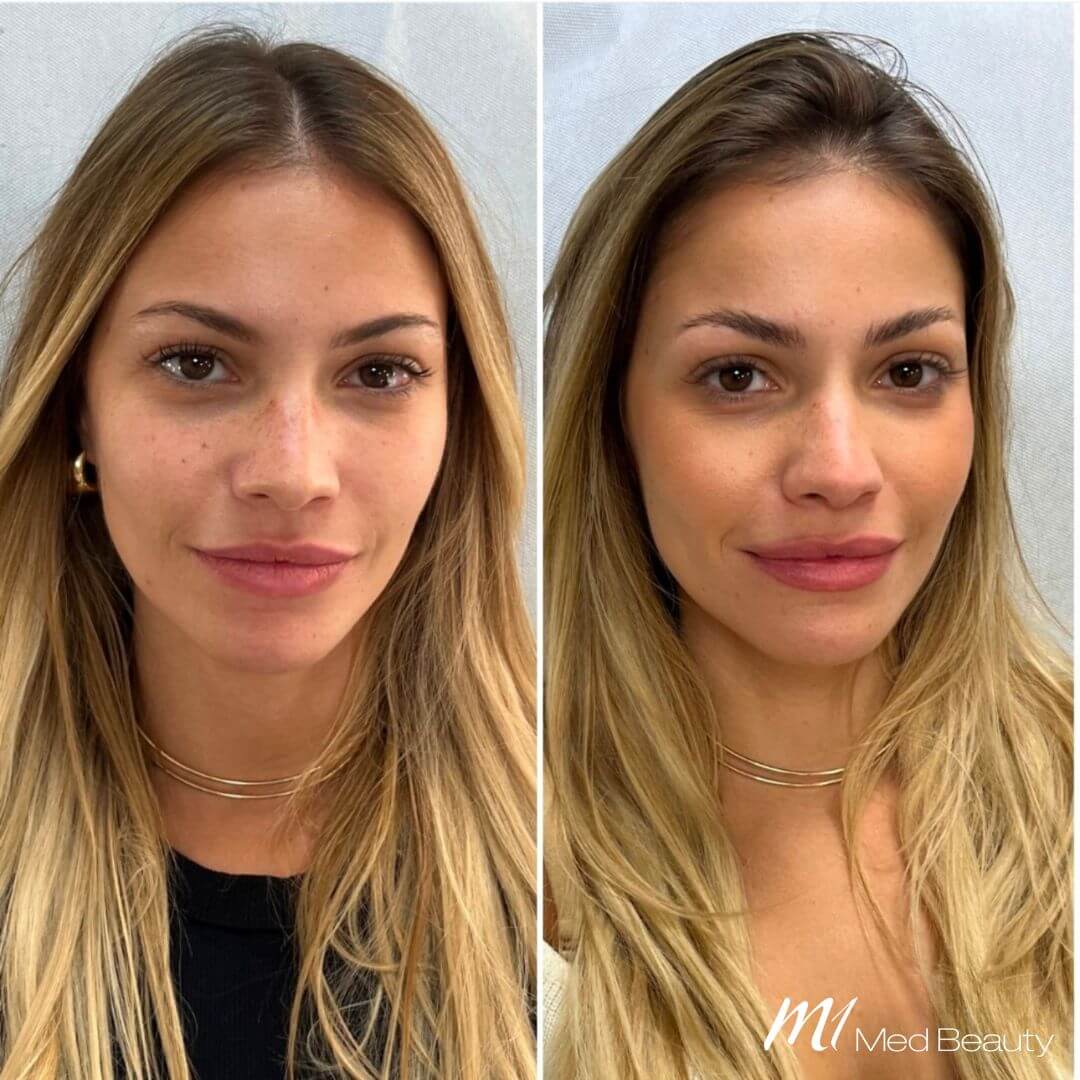 Skin booster M1 Beauty (1)