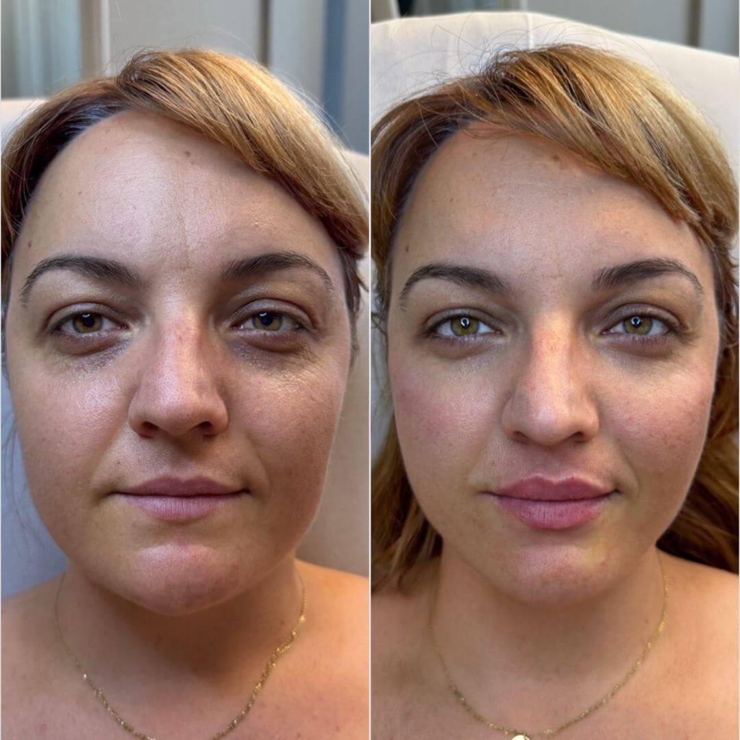 Skin booster M1 Beauty (3)