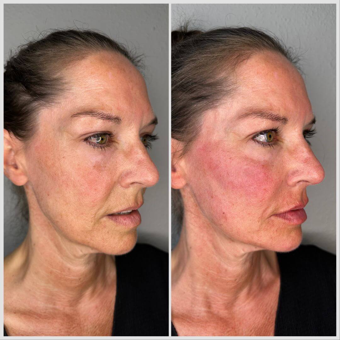 Skin booster M1 Beauty (4)